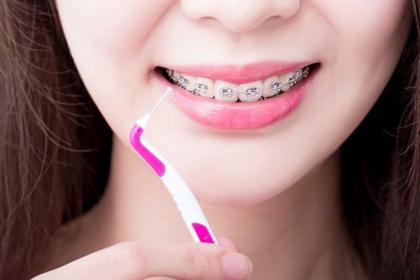 Perawatan Gigi Behel